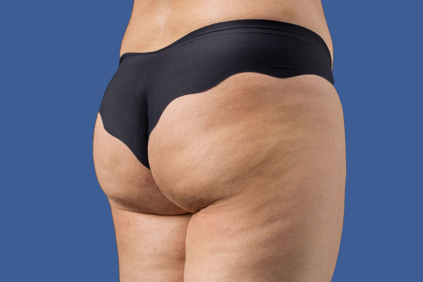 Cellulite sui fianchi